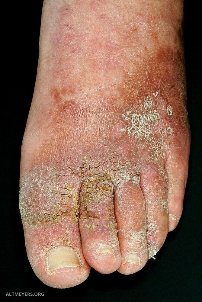 papillomatosis in lymphedema pentru a vindeca micii viermi
