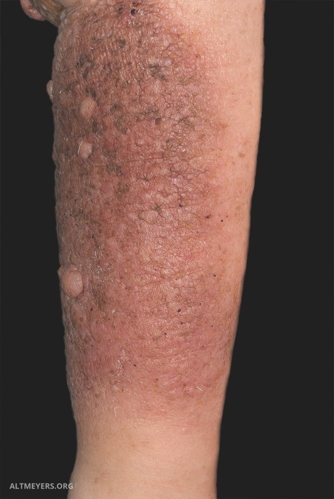 Papillomatosis cutis lymphostatica histology. Familial cancer submit