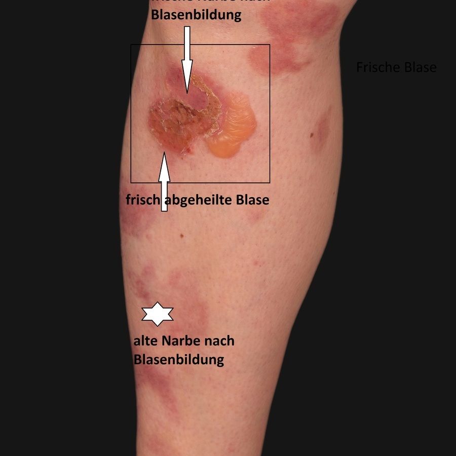 Frontiers  Epidermolysis Bullosa Acquisita: The 2019 Update