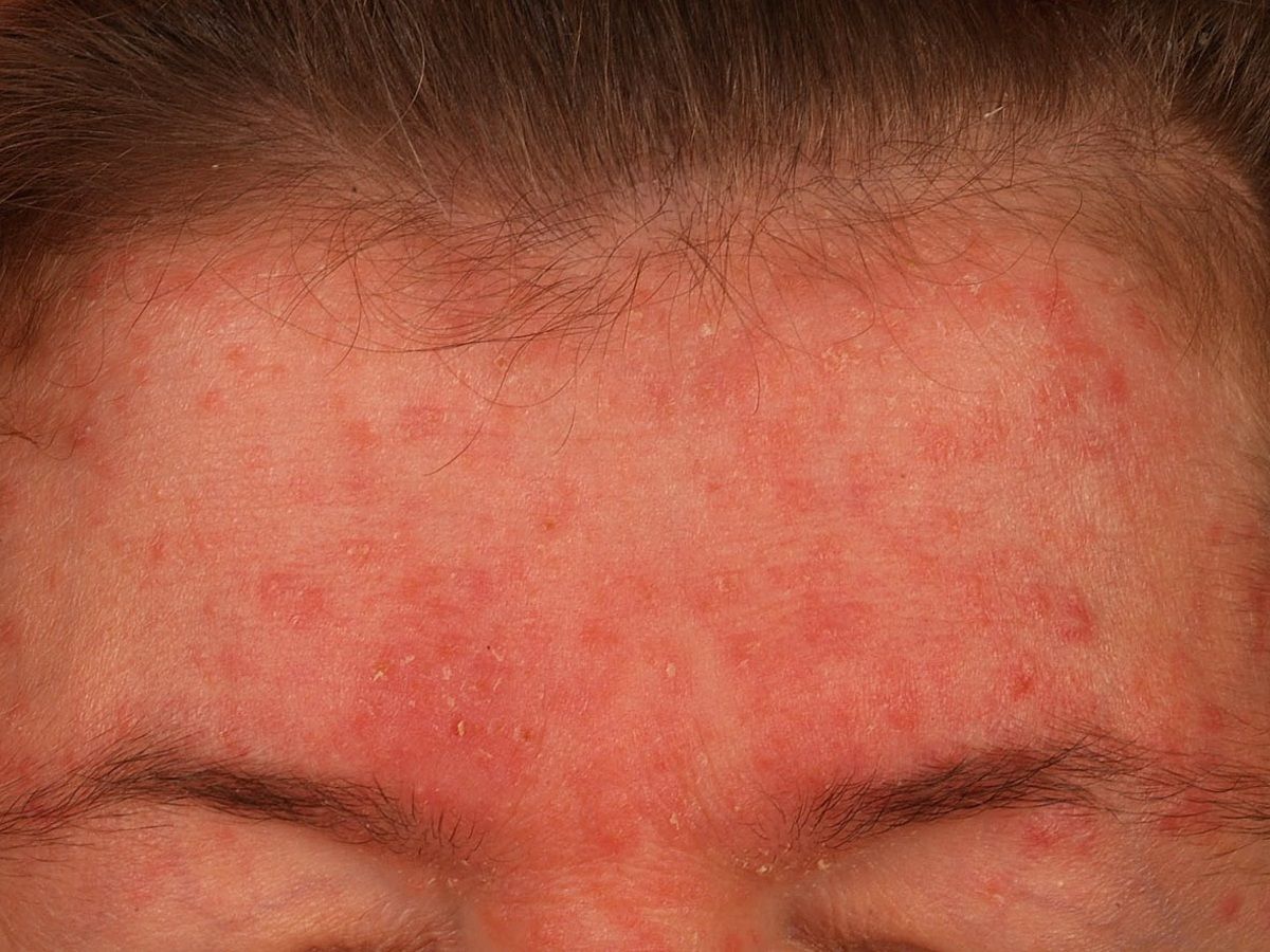 Seborrhoische Dermatitis Des Erwachsenen Altmeyers Enzyklopadie Fachbereich Dermatologie