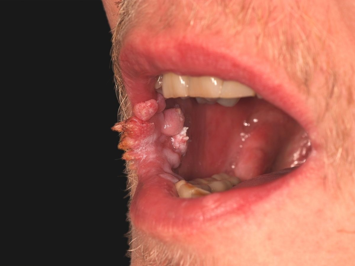 florid papillomatosis what is it