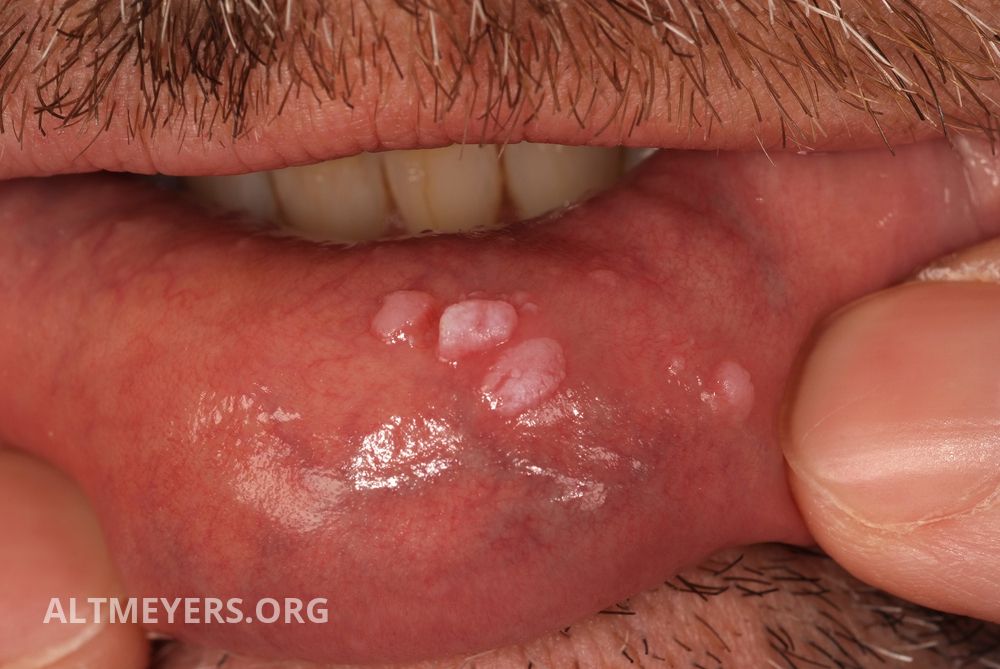 oral verruca vulgaris