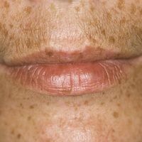 Lentigo simplex Bilder Altmeyers Enzyklopädie Fachbereich Dermatologie