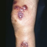 Pyoderma gangraenosum Images - Altmeyers Encyclopedia - Department ...