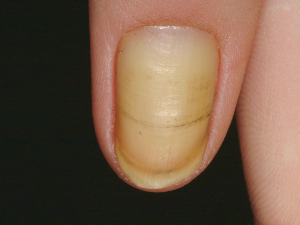 Yellow Nail Syndrom Altmeyers Enzyklopadie Fachbereich Dermatologie