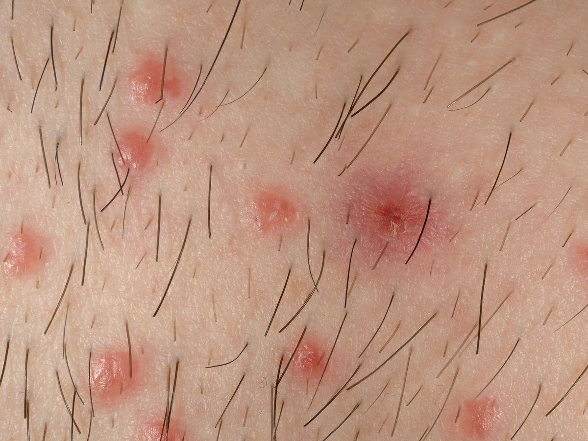 Pityriasis Lichenoides Chronica Altmeyers Encyclopedia Department Dermatology