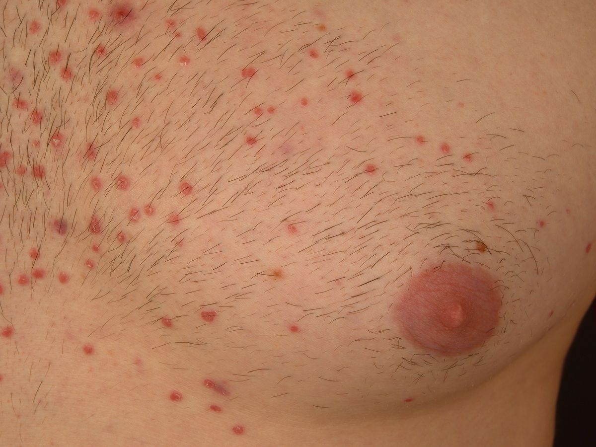Pityriasis Lichenoides Chronica Altmeyers Encyclopedia Department Dermatology