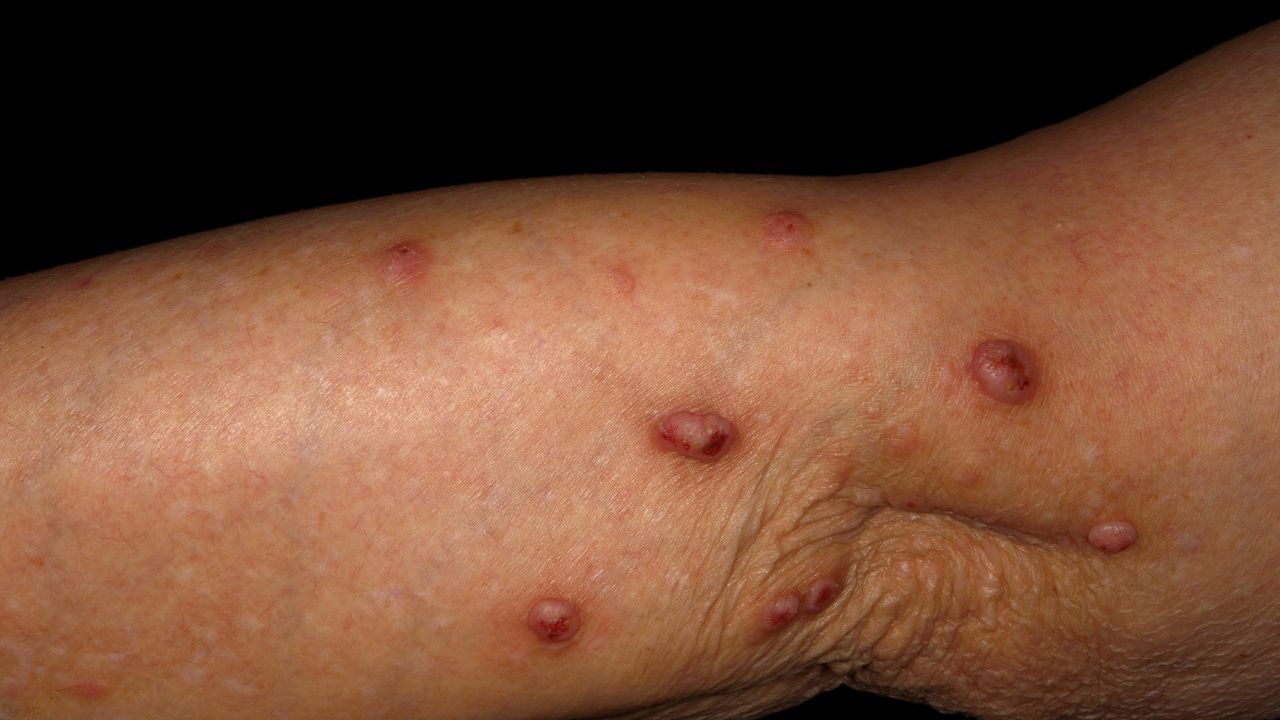 Keratoakanthome multiple eruptive - Altmeyers Enzyklopädie - Fachbereich  Dermatologie, image size:1280x720