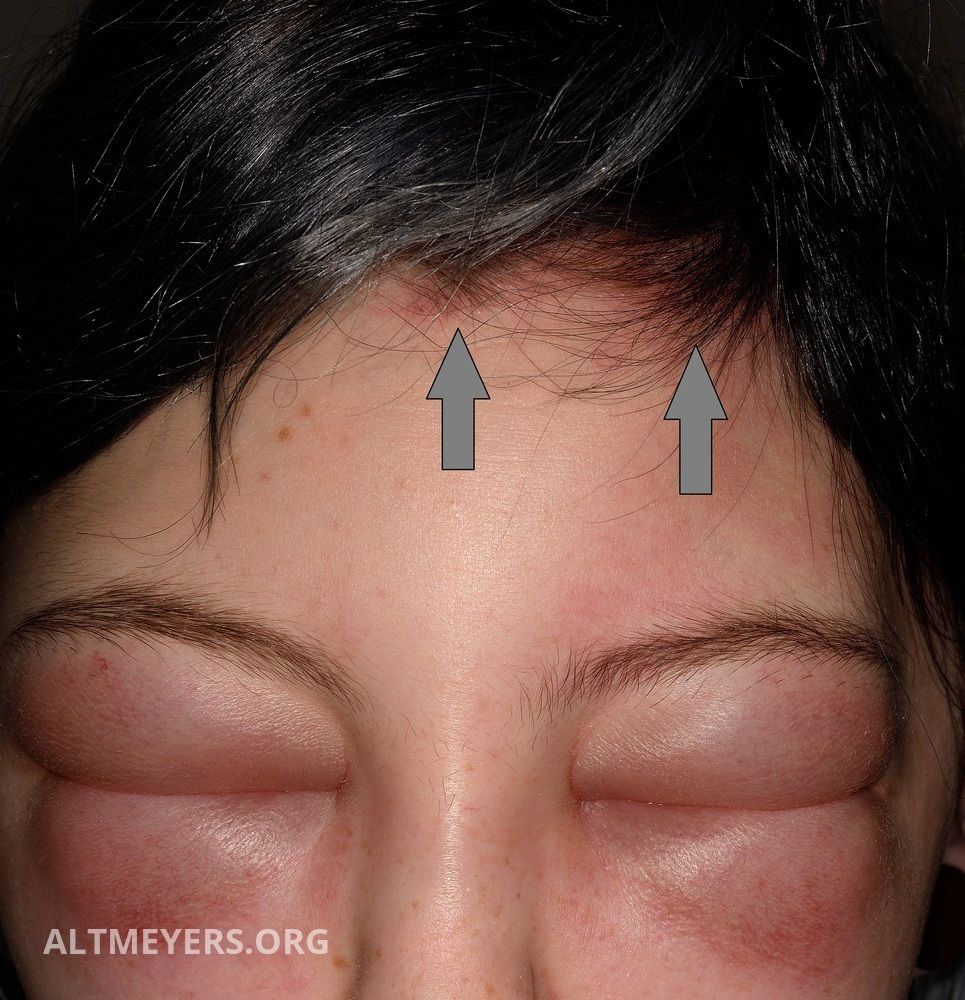 Kontaktdermatitis Der Kopfhaut Allergische Altmeyers Enzyklopadie Fachbereich Dermatologie