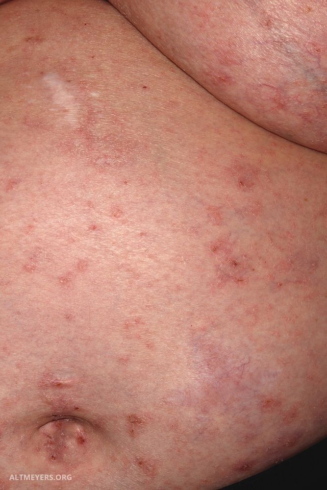 Skabies Altmeyers Enzyklopadie Fachbereich Dermatologie