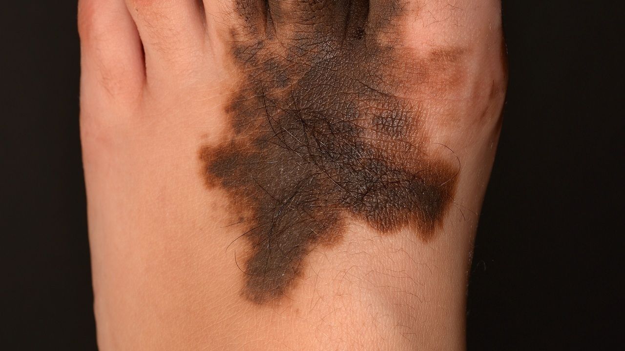 melanocytic nevus palm