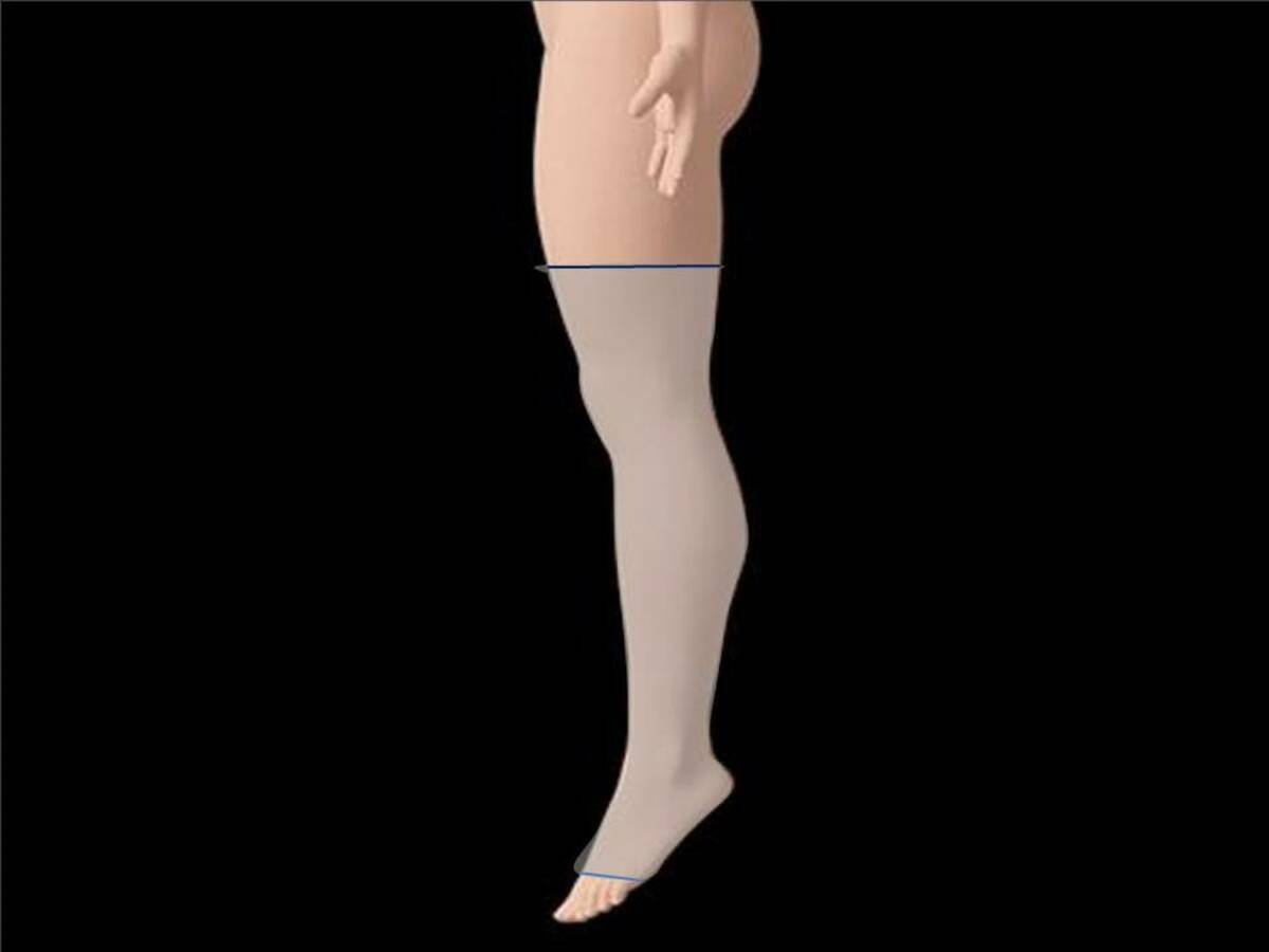 Flat knit compression - Altmeyers Encyclopedia - Department Vascular  medicine