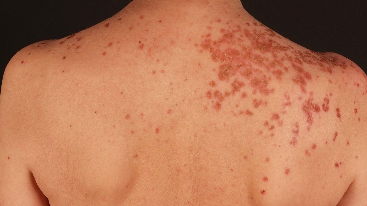 Eccema Herpeticatum Altmeyers Encyclopedia Department Dermatology Eccema Herpeticatum Altmeyers Encyclopedia Department Dermatology