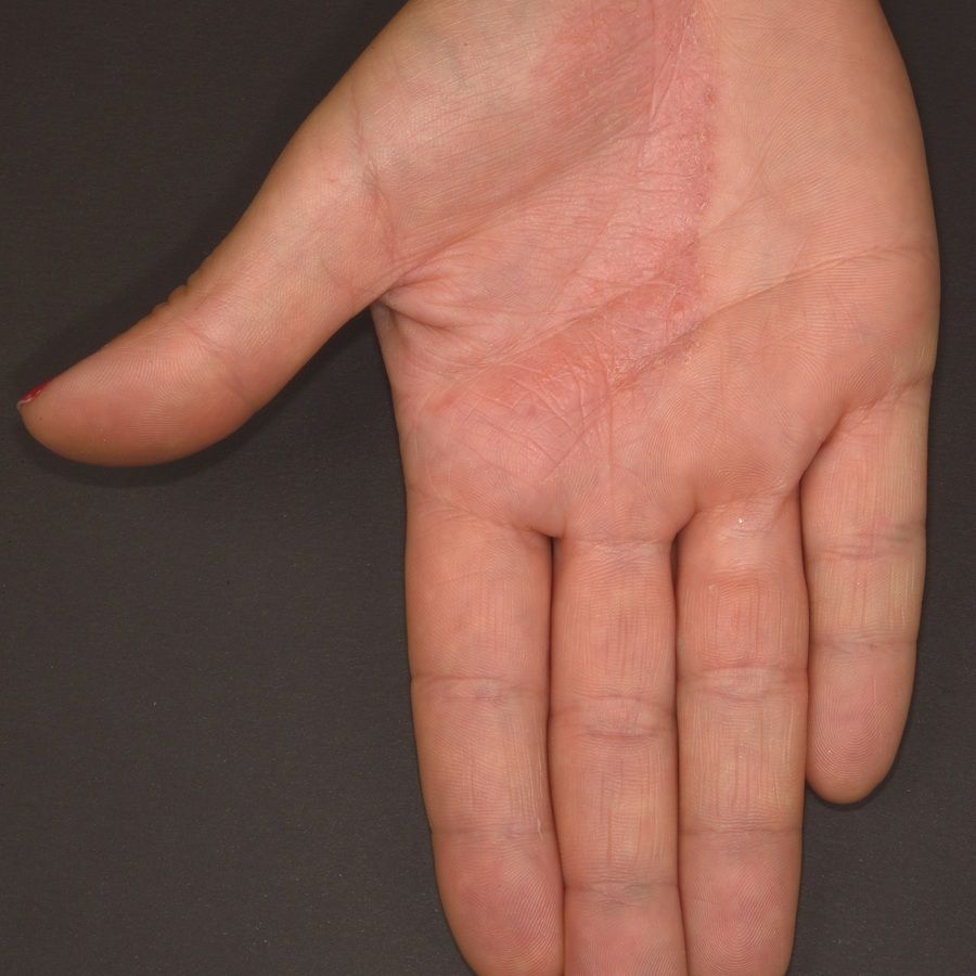 Ringworm - tinea manuum on the finger: MedlinePlus Medical Encyclopedia  Image