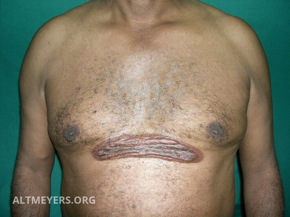 Keloid (overview) - Altmeyers Encyclopedia - Department Dermatology Keloid (overview) - Altmeyers Encyclopedia - Department Dermatology