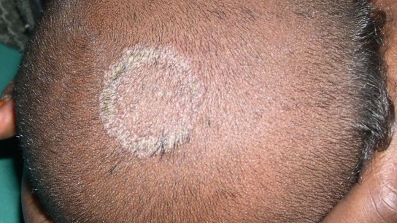 Tinea capitis (overview) - Altmeyers Encyclopedia - Department Dermatology