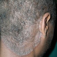 Tinea capitis superficialis Images - Altmeyers Encyclopedia ...