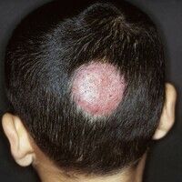 Tinea capitis profunda Images - Altmeyers Encyclopedia - Department ...