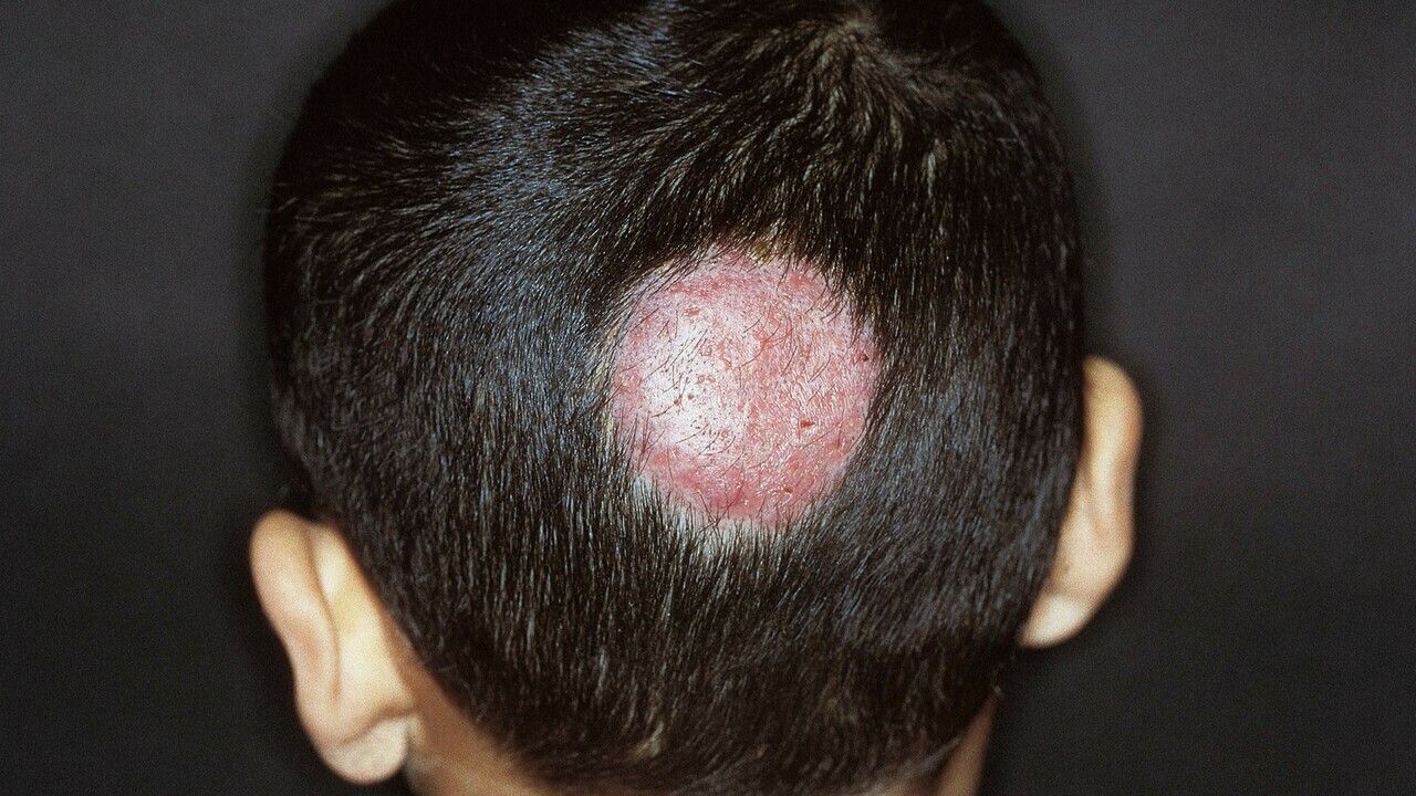 Tinea capitis (overview) - Altmeyers Encyclopedia - Department