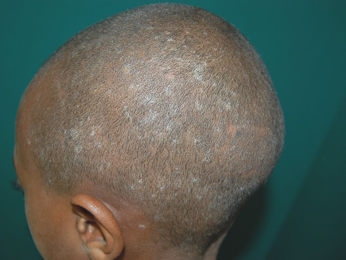 Superficial tinea capitis - Altmeyers Encyclopedia - Department Dermatology