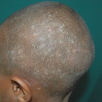 Tinea capitis superficialis Images - Altmeyers Encyclopedia ...