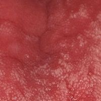 Plaques muqueuses Images - Altmeyers Encyclopedia - Department Dermatology