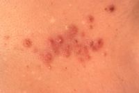 Folliculitis barbae - Altmeyers Encyclopedia - Department Dermatology