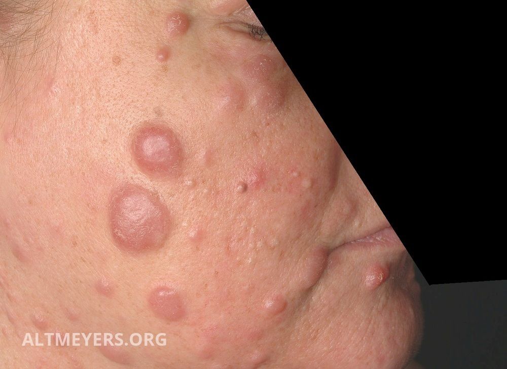 Mycosis Fungoides Plaque Stage