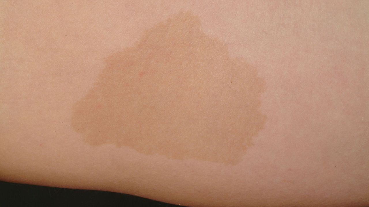 pix Café Au Lait Skin cafe au lait stain altmeyers