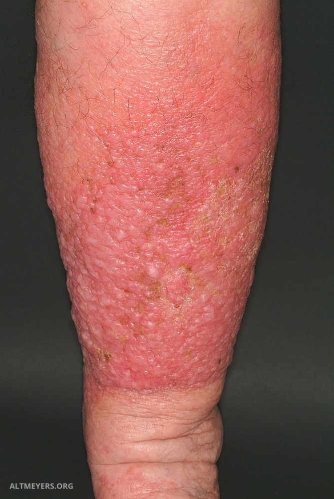 Papillomatosis in lymphedema