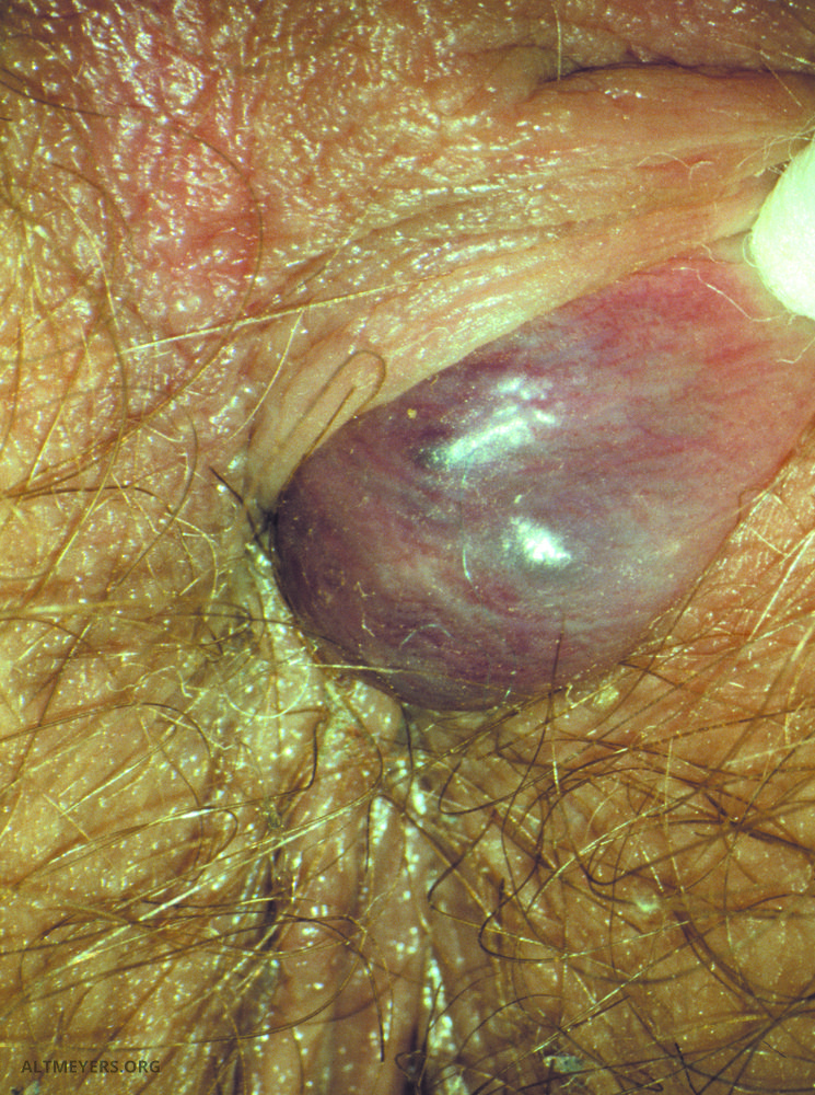 Anal thrombose The Rectum,