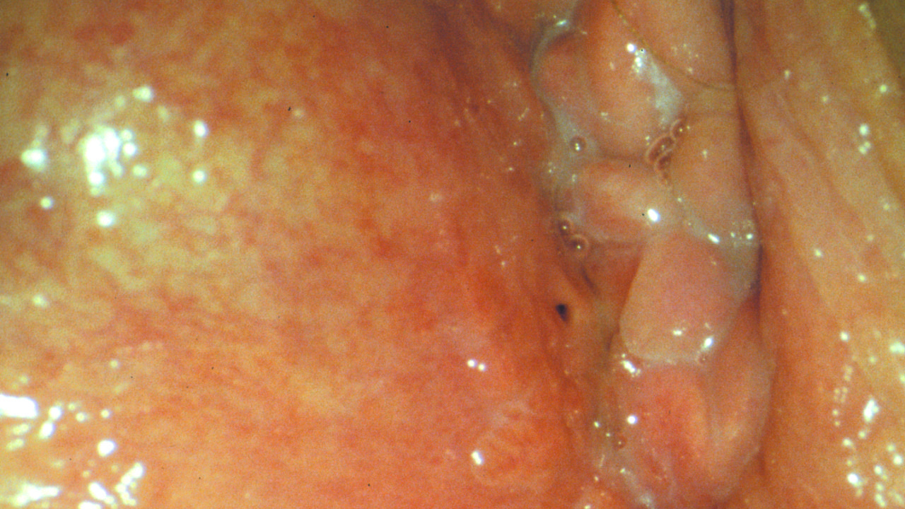 Abszess im bauch wie lange dauert die heilung Abszess im bauch wie lange dauert die heilung