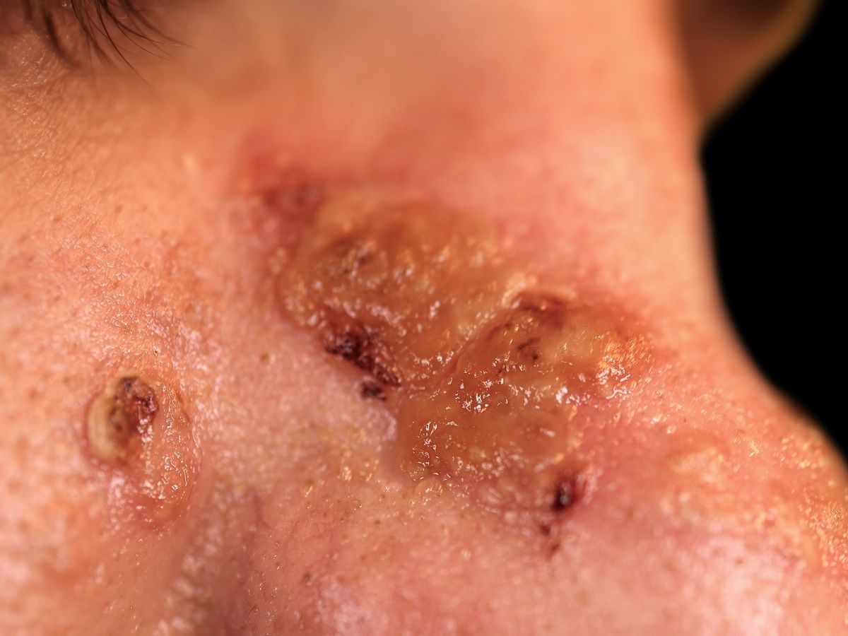 Impetigo Contagiosa Kleinblasige Altmeyers Enzyklopadie Fachbereich Dermatologie