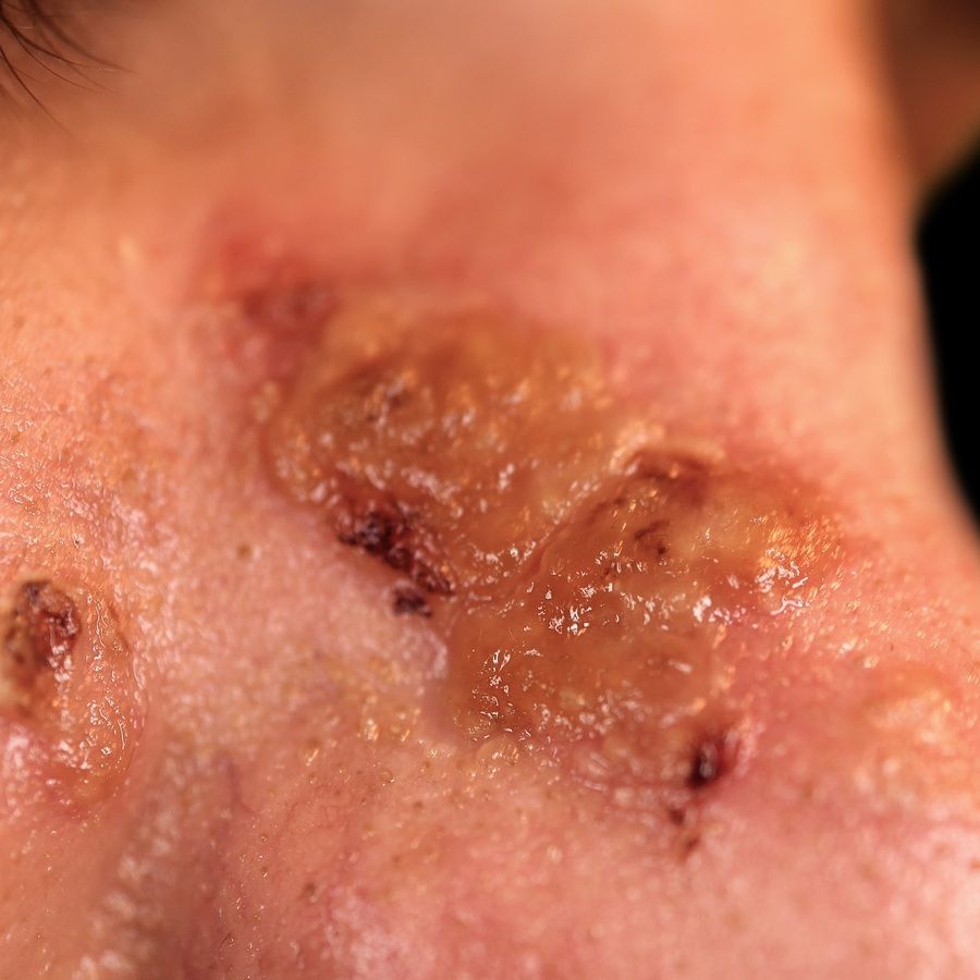 Impetigo Contagiosa Kleinblasige Altmeyers Enzyklopadie Fachbereich Dermatologie