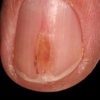 Onychodystrophie (Übersicht) Bilder Altmeyers Enzyklopädie