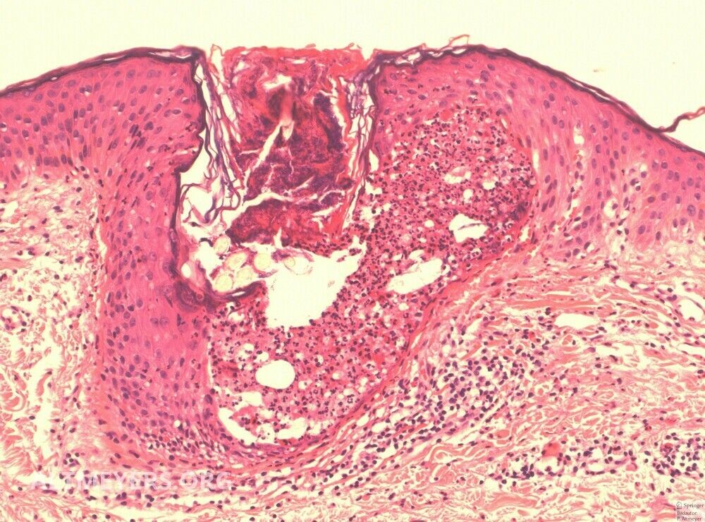 Follikulitis Superfizielle Altmeyers Enzyklopadie Fachbereich Dermatologie