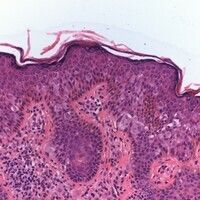 Morbus Paget extramammärer Bilder Altmeyers Enzyklopädie