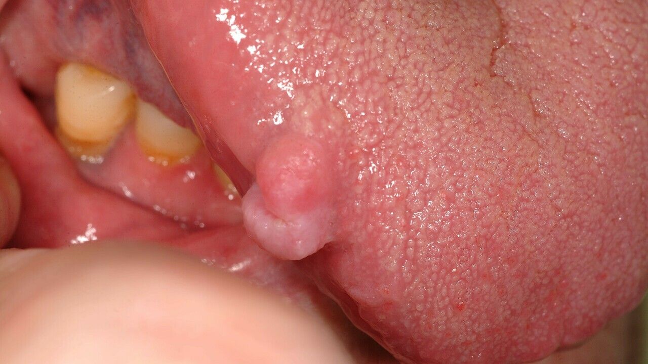 asportazione papilloma occhio cancerul neuroendocrin