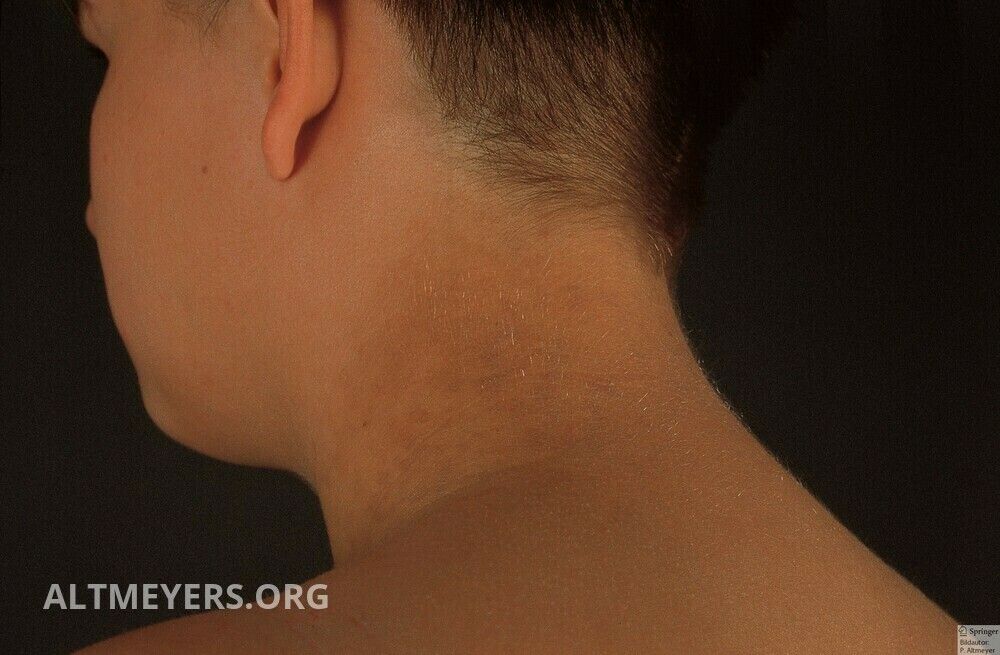 papillomatosis confluent et reticularis cum se poate elimina papilomul prin fir
