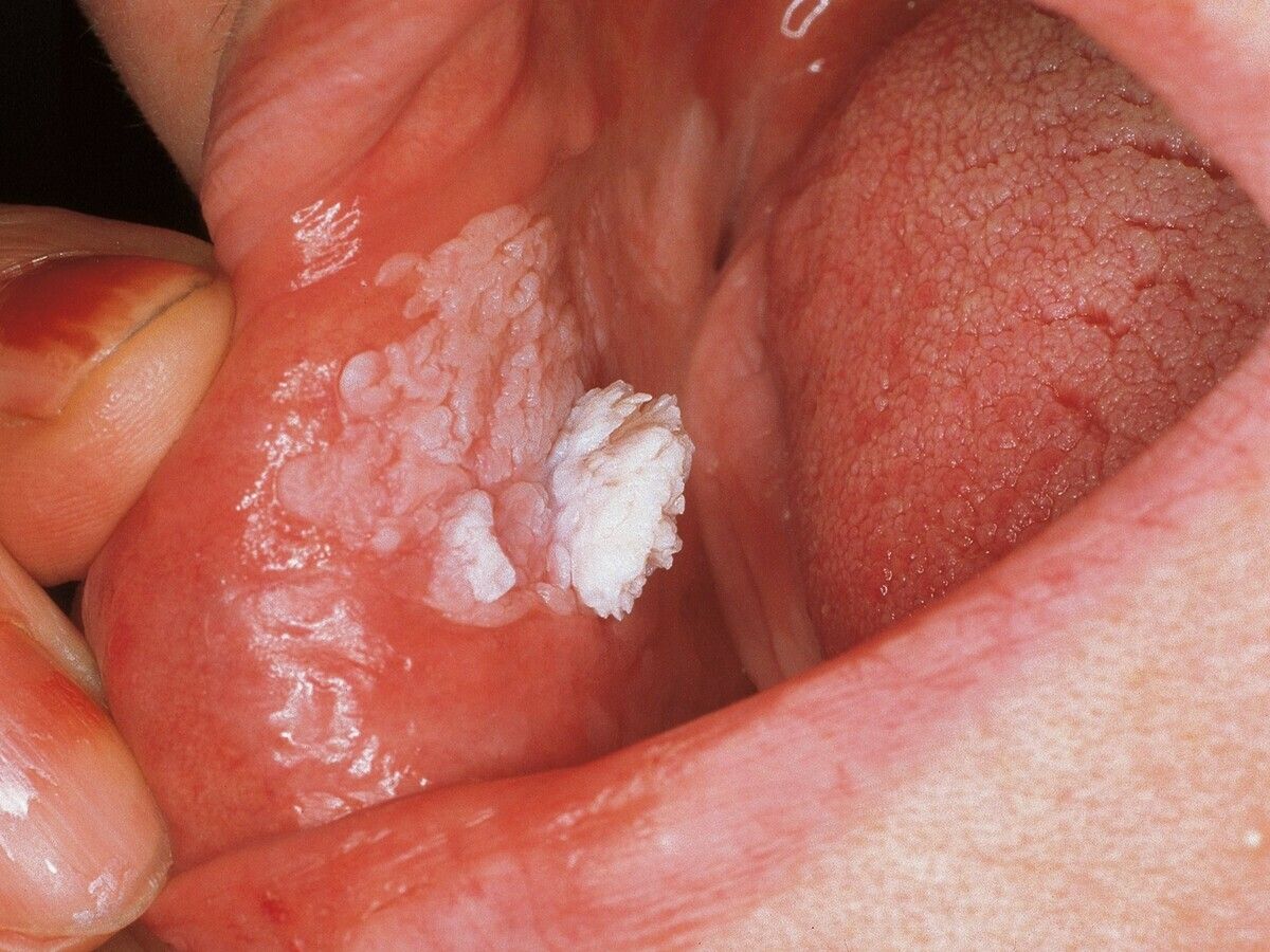 papilloma virus nasale împingând simptomele paraziților