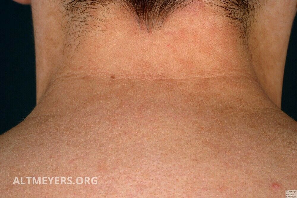 papillomatosis cutis confluens et reticularis