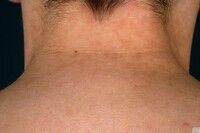 papillomatosis cutis confluens et reticularis
