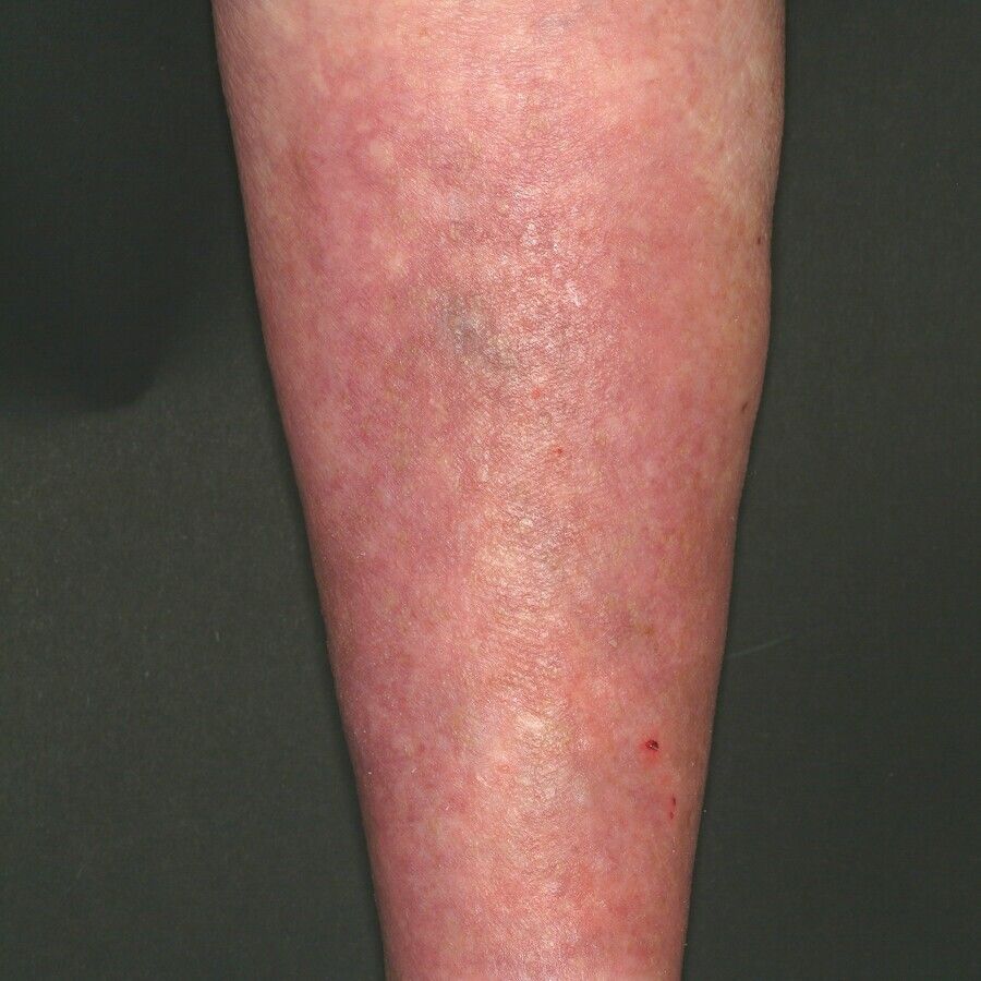 cum să faci față verucilor genitale vaccinazione papilloma virus uomo