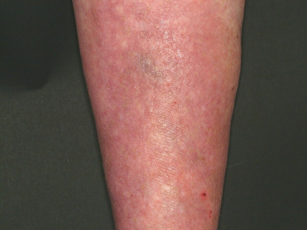 papillomatosis cutis reticularis