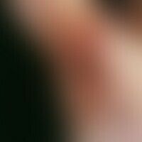 Pityriasis rubra pilaris. M... Pityriasis rubra pilaris. Multiple, chronisch dynamische (wechselnder Verlauf; Verschlechterung i...
