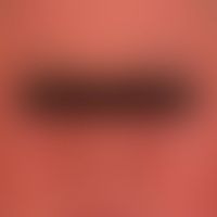 Pityriasis rubra pilaris (a... Pityriasis rubra pilaris (adulter Typ): schubhaft aufgetretende, eythrodermische Maximalvariante...