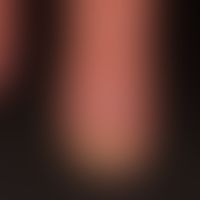 Pityriasis rubra pilaris. C... Pityriasis rubra pilaris. Chronische, nicht spezifische Onychodystrophie. Kompletter Verlust des ...