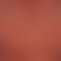 Pityriasis rubra pilaris. E... Pityriasis rubra pilaris. Erythrodermische Maximalvariante der Pityriasis rubra pilaris.