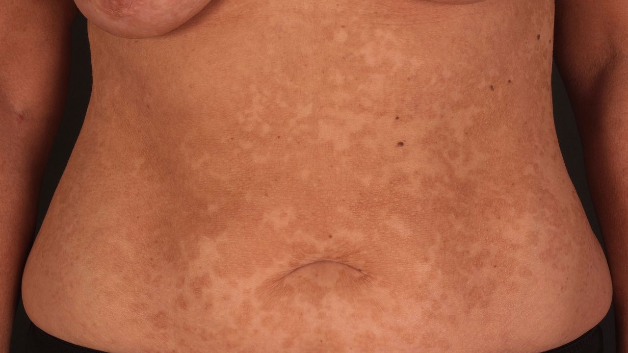 Pityriasis Versicolor Ubersicht Altmeyers Enzyklopadie Fachbereich Dermatologie