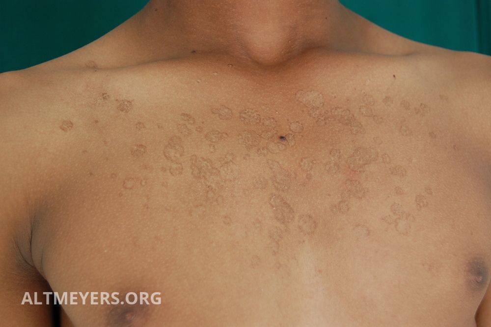 Pityriasis Versicolor Ubersicht Altmeyers Enzyklopadie Fachbereich Dermatologie